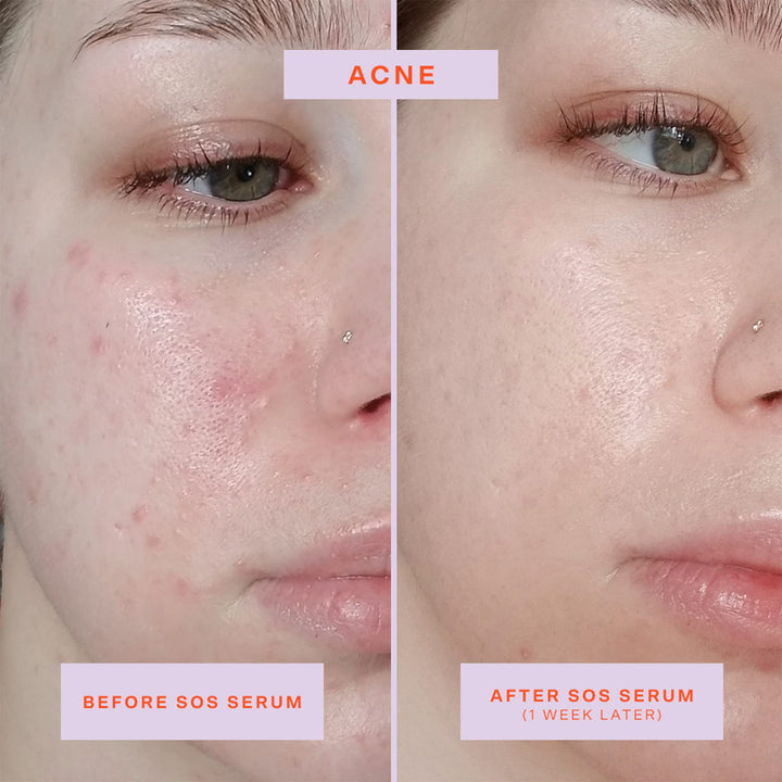 SOS Intensive Redness Relief Serum with Hypochlorous Acid - GLAM MODA