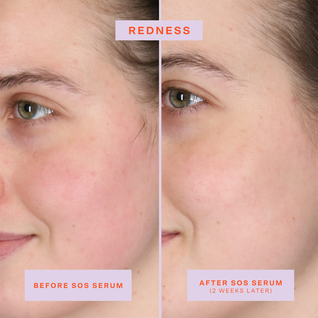 SOS Intensive Redness Relief Serum with Hypochlorous Acid - GLAM MODA