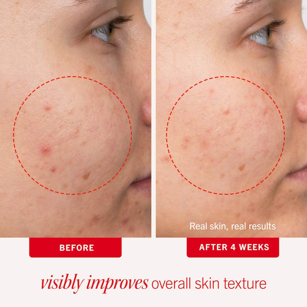 Acne Clearing Pads - 2% Salicylic Acid Acne Treatment - GLAM MODA