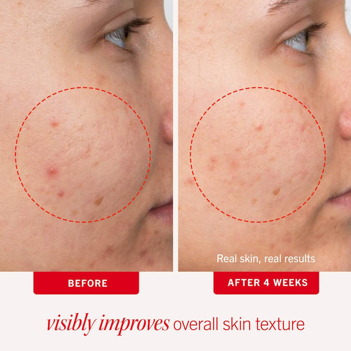 Acne Clearing Pads - 2% Salicylic Acid Acne Treatment - GLAM MODA
