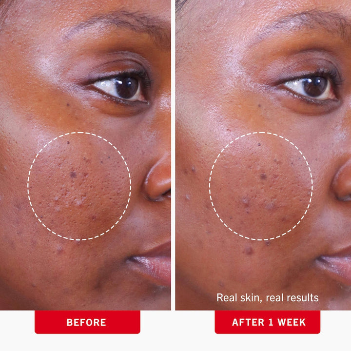 Acne Clearing Pads - 2% Salicylic Acid Acne Treatment - GLAM MODA