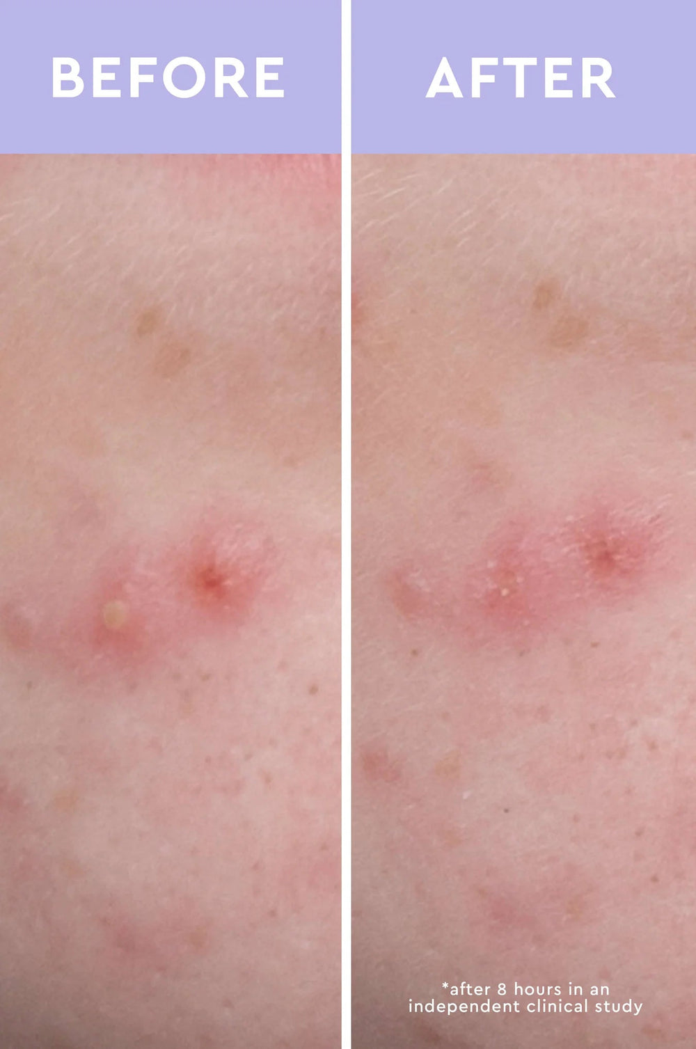 Spot A Spot Acne Patches - GLAM MODA