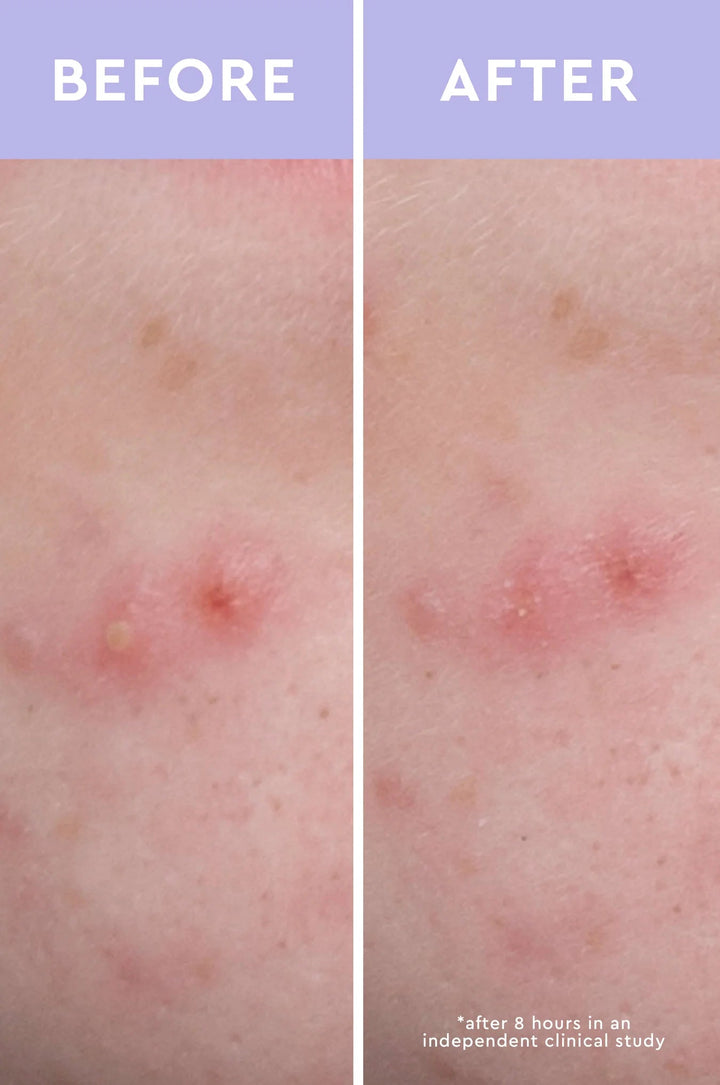 Spot A Spot Acne Patches - GLAM MODA