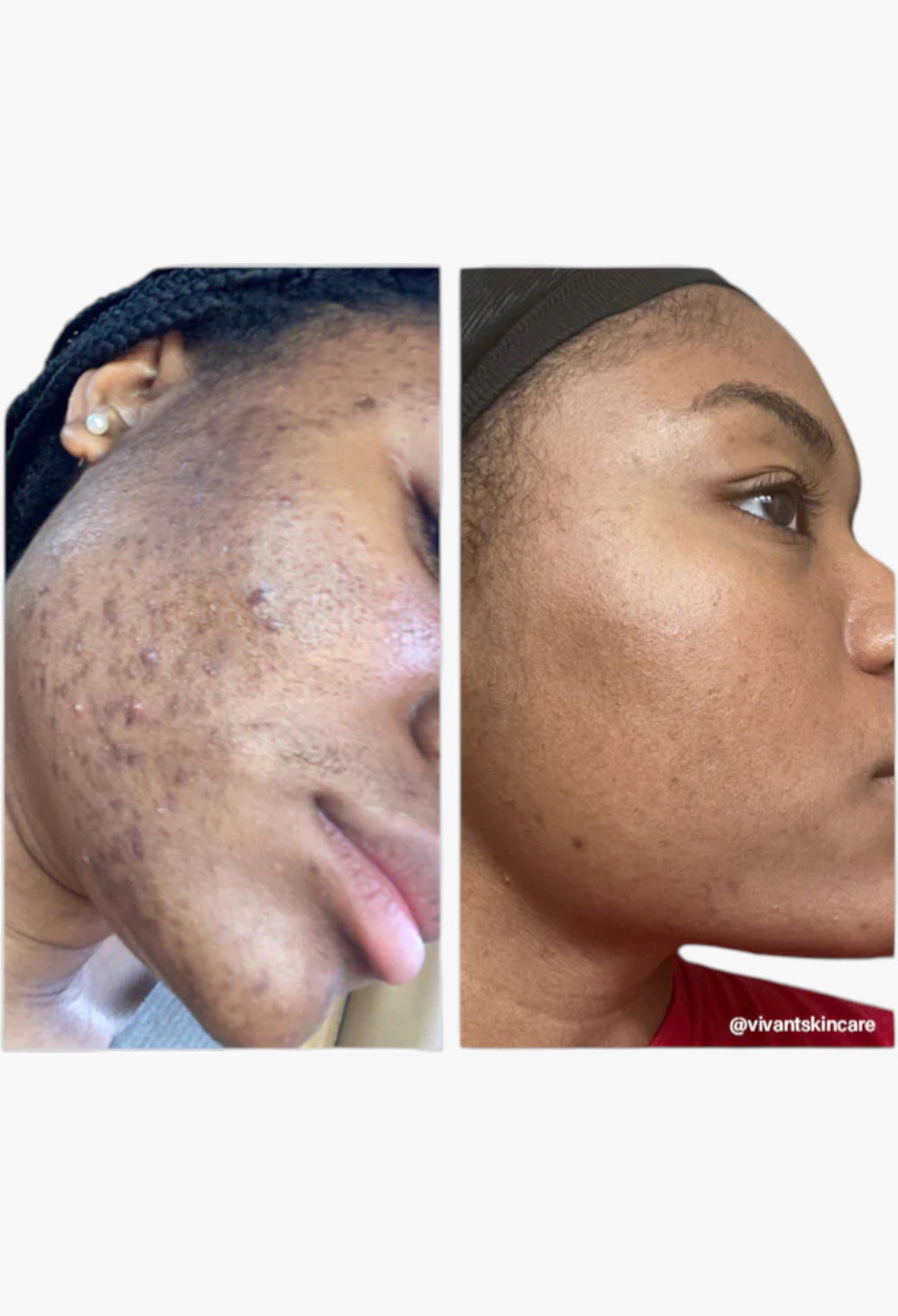 8% Mandelic Acid Serum - GLAM MODA