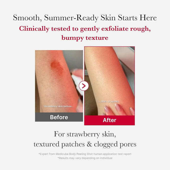 Red Acne Body Peeling Shot ( Not For Face ) - GLAM MODA