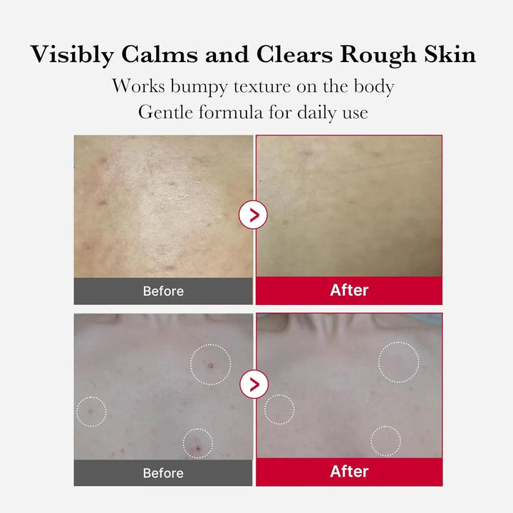Red Acne Body Peeling Shot ( Not For Face ) - GLAM MODA