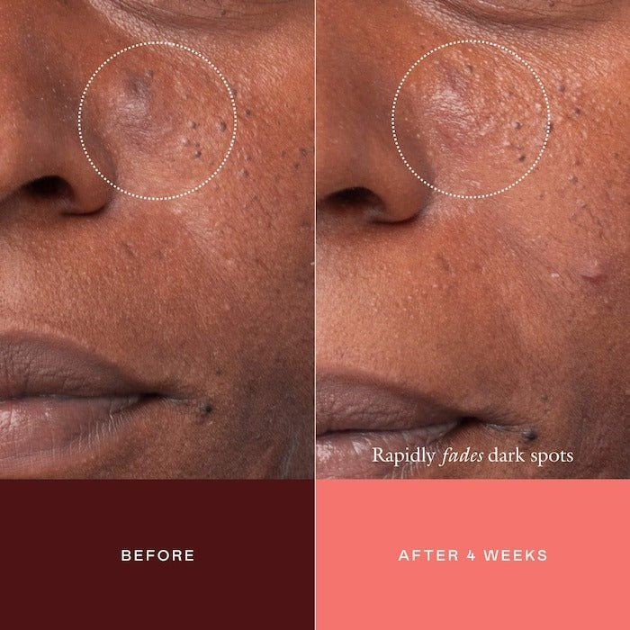 The Mark Advanced Targeted Dark Spot Concentrate with 5% Tranexamic Acid, 1% Alpha Arbutin & 1% Kojic Acid for Hyperpigmentation, Acne Marks & Age Spots - GLAM MODA