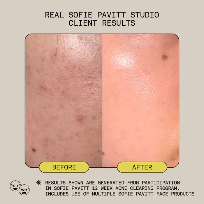 3 Step Acne-Safe Clear Skin System with Mandelic Acid